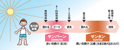 サンバーンとサンタンの違いの図