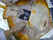 Resection of stingray liver