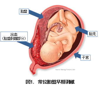 図1.常位胎盤早期剥離