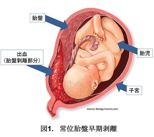 常位胎盤早期剥離を表した図